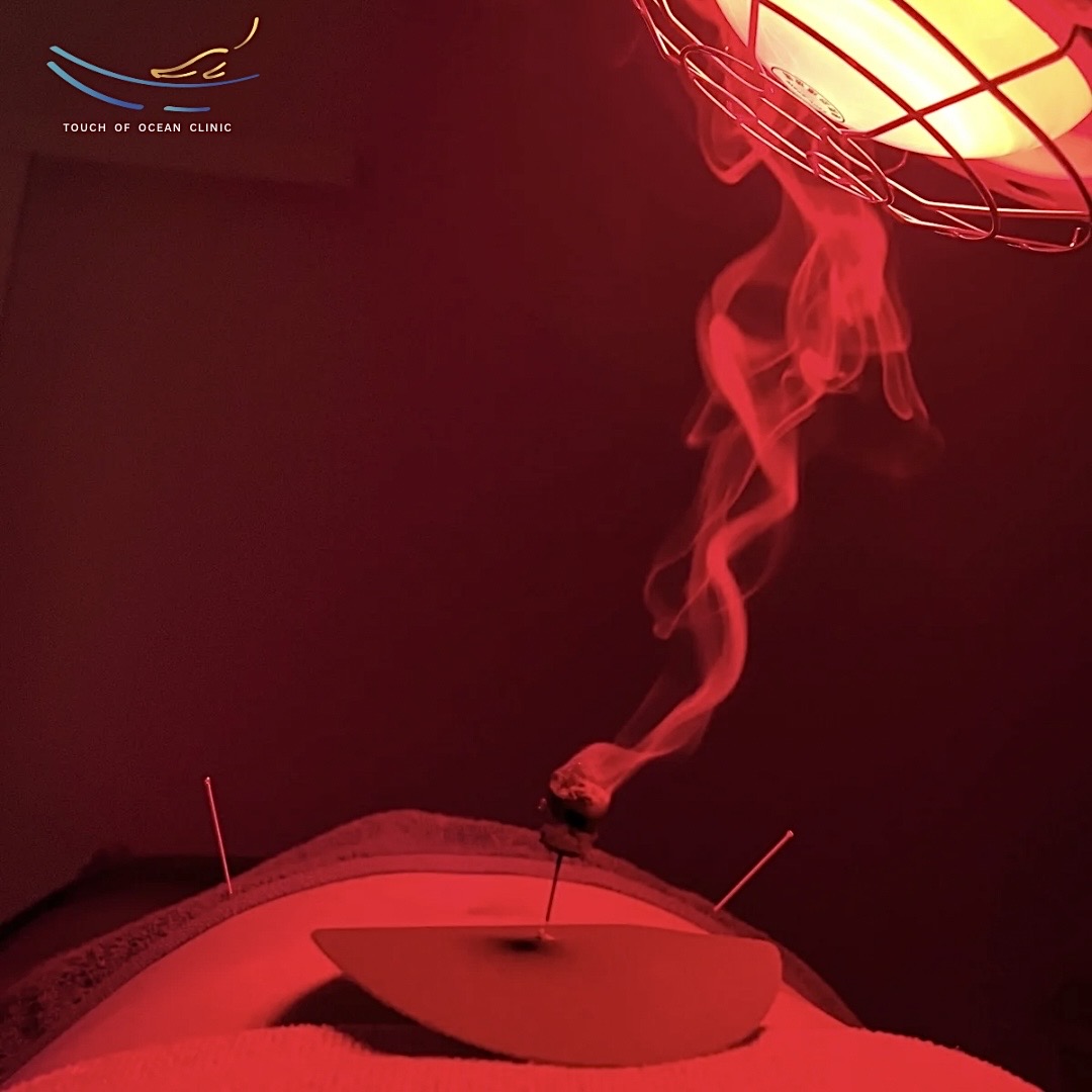 TCM4. รีเซ็ทร่าง:ฝังเข็มปรับสมดุลสภาวะอารมณ์ Reset your body : Acupuncture for emotional balance (60-70นาที/mins)