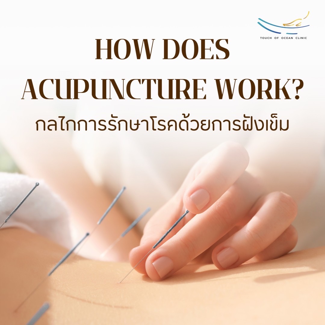 Acupuncture by Doctor