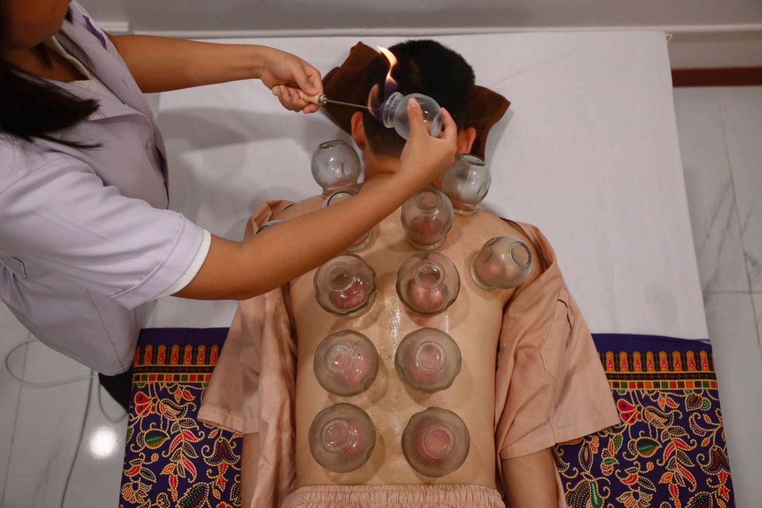 TTM Cupping therapy